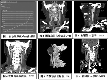 新 多层螺旋ct血管成像(cta)