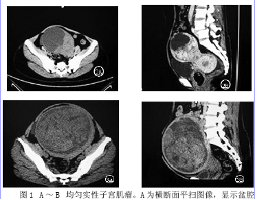 多排螺旋ct多平面重建在子宫肌瘤的应用