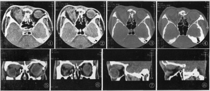 多层螺旋ct在眼眶蜂窝织炎中的应用