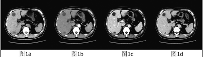 孤立性早期肝脓肿的ct诊断