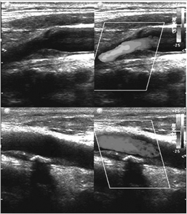 彩色多普勒超声在颈动脉粥样硬化斑块中的诊断价值