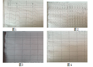 低钾血症导致尖端扭转型室速以及经外周静脉高浓度泵入补钾成功1例