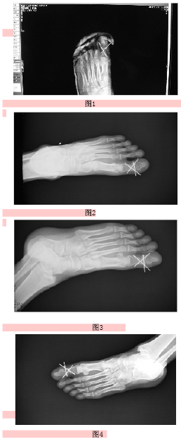 踇趾近节趾骨远端t型骨折的治疗
