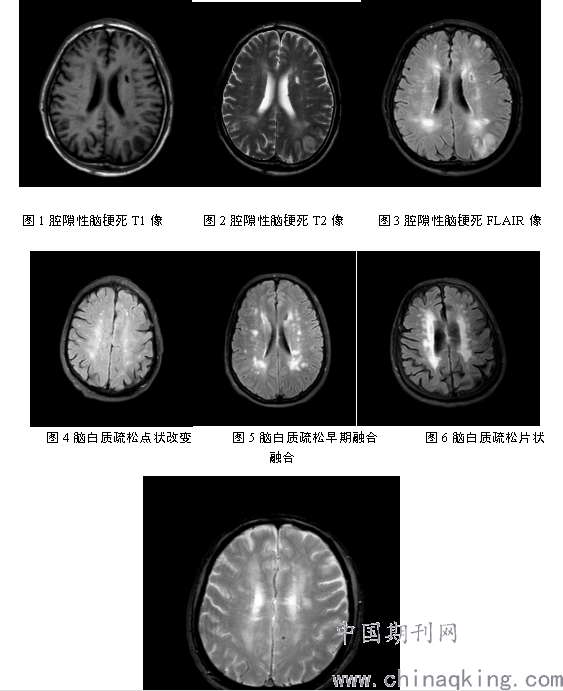 急性轻型脑卒中合并陈旧性腔隙性脑梗死与脑微出血和脑白质疏松的关系