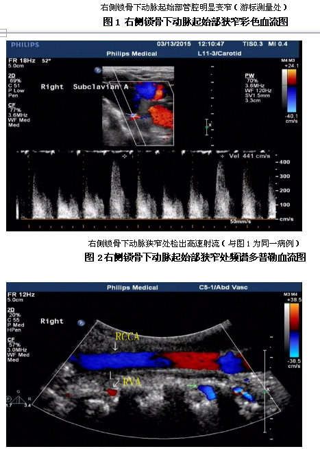 锁骨下动脉盗血综合征的超声诊断要点:(1)锁骨下动脉起始部或无名