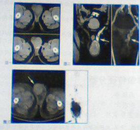 睾丸淋巴瘤的ct影像特征分析