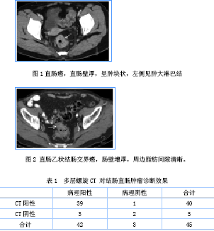 多层螺旋ct诊断结直肠肿瘤临床价值探讨