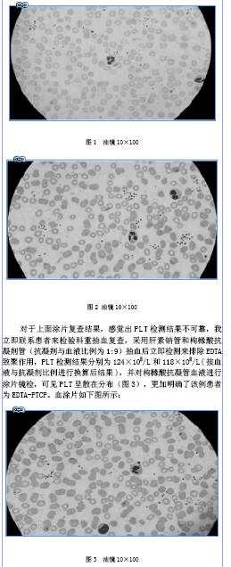 浅谈edta-k2依赖性假性血小板减少症对血小板计数的影响