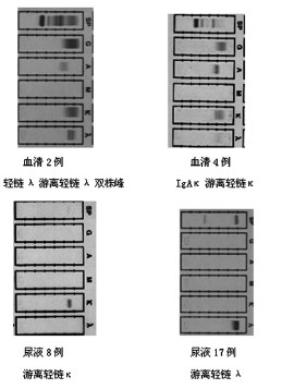 免疫固定电泳在96 例骨髓瘤肾脏病患者诊断中的意义