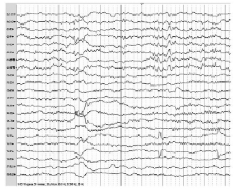 改良蝶骨电极与毫针蝶骨电极在癫痫诊断中的对比