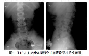 胸腰段椎体休门氏病所致脊柱后凸畸形一例