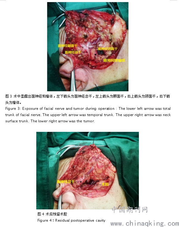 改良的经腮腺径路咽旁间隙肿瘤切除术