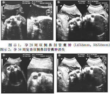 胎儿鼻泪管囊肿的超声诊断及临床意义