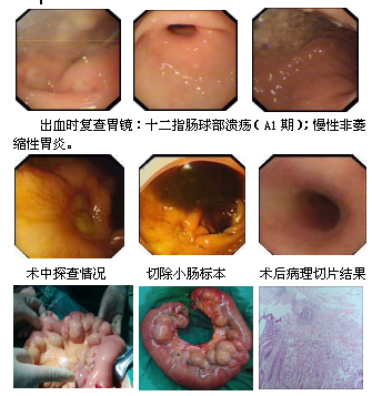 小肠多发憩室并出血1例诊治分析