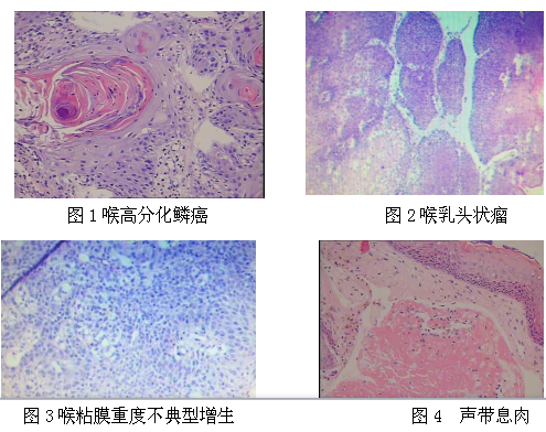 喉癌,喉部粘膜不典型增生,喉乳头状瘤及声带息肉组织的dna倍体结果,高