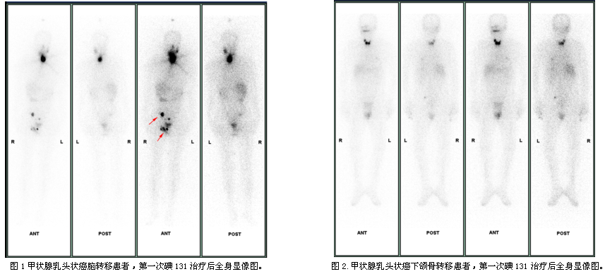 图1甲状腺乳头状癌脑转移患者,第一次碘131治疗后全身显像图.