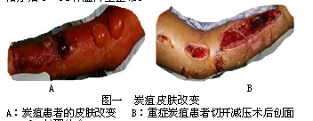 4例皮肤炭疽患者的临床特征与护理