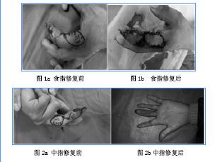 指动脉带蒂逆行岛状皮瓣移植修复指端创面