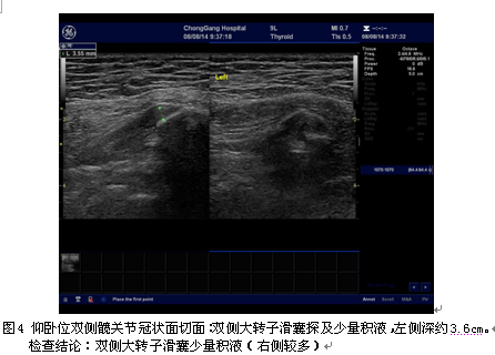 2]髋关节周围有丰富的肌肉等软组织,少量积液和轻度软组织肿胀常无