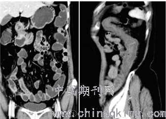 肠系膜动脉供血障碍性肠缺血肠管可逆性ct表现探讨