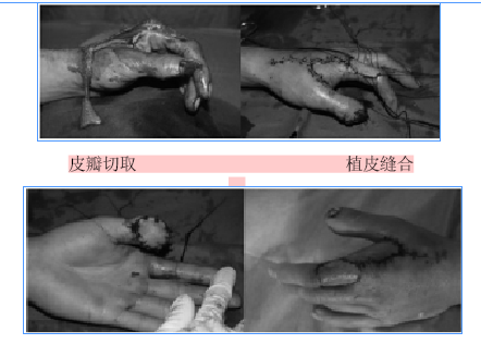 第一掌背动脉血管复合蒂岛状皮瓣在手指外伤中的临床应用