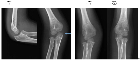 儿童肘关节损伤的dr诊断体会