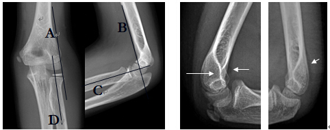儿童肘关节骨折及脱位的dr诊断[j].海南医学,2010,21(19):102-103.