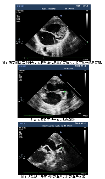 超声心动图诊断单心房,单心室合并共同动脉干
