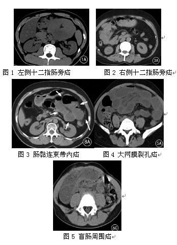 腹内疝的螺旋ct诊断分析