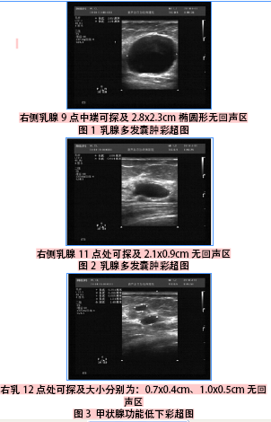 超声诊断乳腺多发囊肿1例