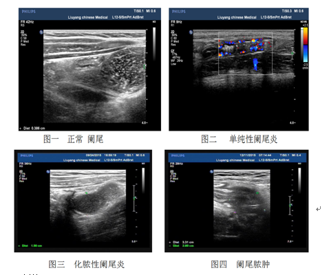 彩超检查对阑尾炎的诊断及超声分型的临床价值