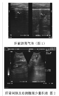 超声检查诊断急性胃肠道穿孔13例报道