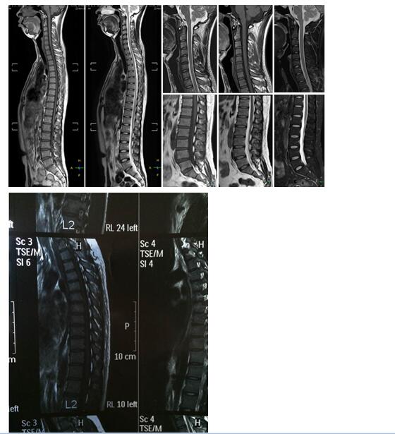 脊柱损伤诊断中磁共振技术的诊断效果研究