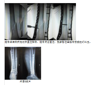 经皮mippo治疗胫骨远端骨折的临床体会及手术技巧