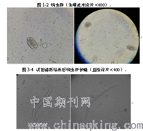 粪类圆线虫和钩虫感染各一例及资料复习