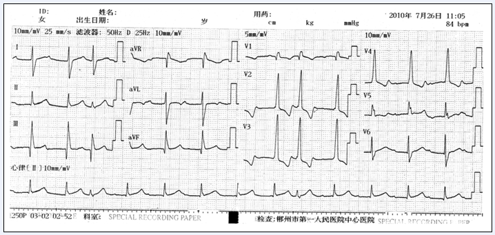 法洛四联症患者术后见房室传导文氏现象伴超常传导1例