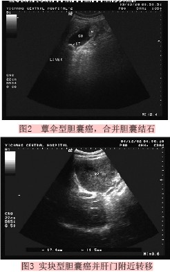 原发性胆囊癌的超声诊断价值