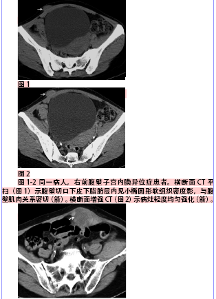 腹壁子宫内膜异位症的临床及ct特征