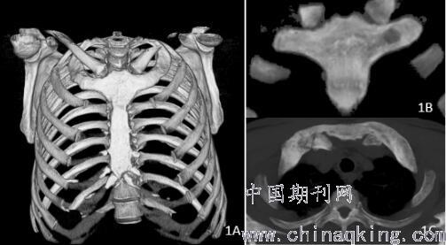 双侧第一肋胸关节处骨质破坏,边缘增生硬化,局部融合,呈"牛头征.