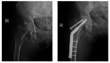 动力髋螺钉结合大转子部空心加压钉治疗股骨转子间骨折