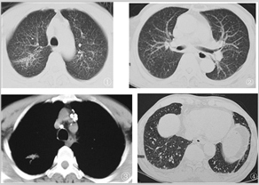 矽肺的ct表现分析