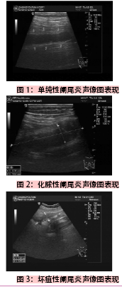 彩色多普勒超声对老年性阑尾炎的诊断价值