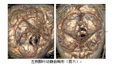 cta对脑动静脉畸形的诊断价值