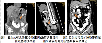 泛影葡胺联合多平面重建在粘连性肠梗阻诊疗中的应用价值