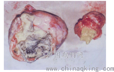 畸胎瘤起初基本没有什么明显症状,一般小的畸胎瘤