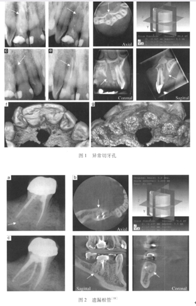 (五)诊断牙根折断或纵裂     牙根折断或纵裂一般不易在根尖片上