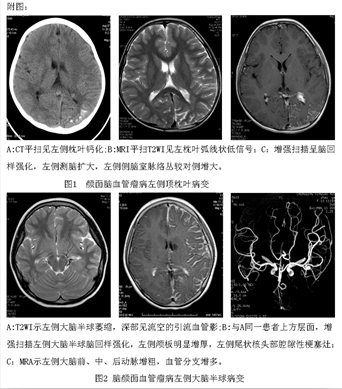 脑颜面血管瘤病的mri表现(附5例报告)