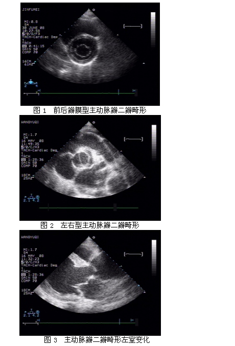超声心动图在主动脉瓣二瓣畸形诊断及术后评价中的价值