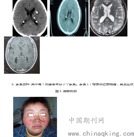 以癫痫首发的结节性硬化临床特征和疗效观察