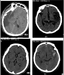 外伤性脑梗死的多层螺旋ct诊断